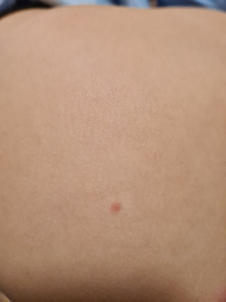 Svědivá vyrážka. Co to může být?