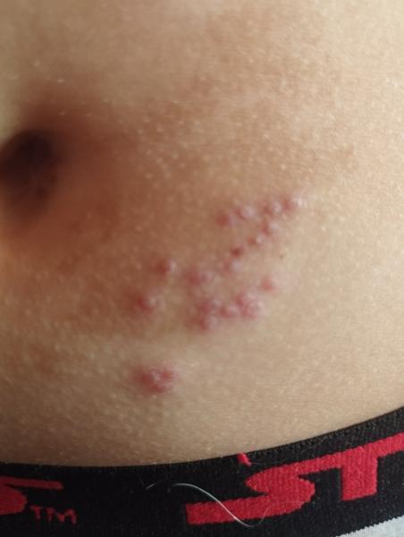 Vyrážka u pupíku u dítěte: Co to může být?