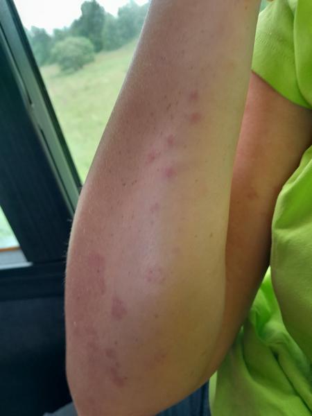 Svědivé pupínky po těle: Jaké jsou možné příčiny?