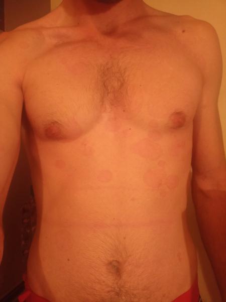 Červené fleky (kolečka) na těle. Co to může být?