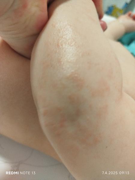 Vyrážka u dcerky. Jaké jsou možné příčiny a řešení?