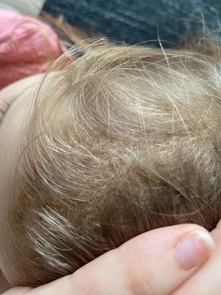 Jak se efektivně zbavit problémů s pokožkou hlavy?