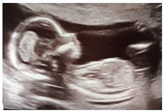 Poznáte pohlaví z ultrazvuku?