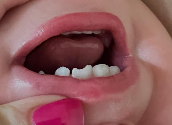 Ulomený mléčný zub u dítěte. Jak řešit?