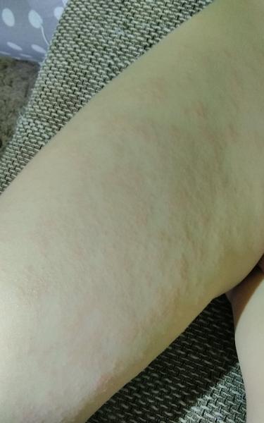 Pupínky hrubší na hmat. Co by to mohlo být?