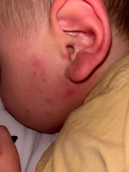 Může se jednat o impetigo?