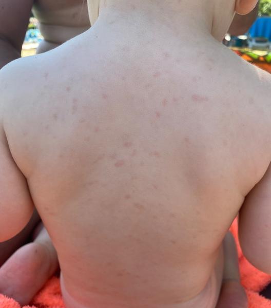 Co způsobuje vyrážku po dvoudenní horečce u dětí?