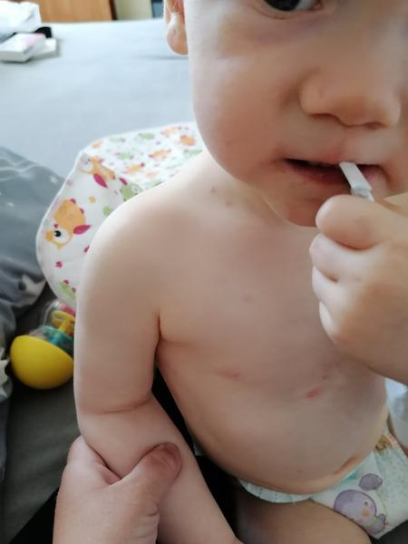 Neštovice. Můžou to být?