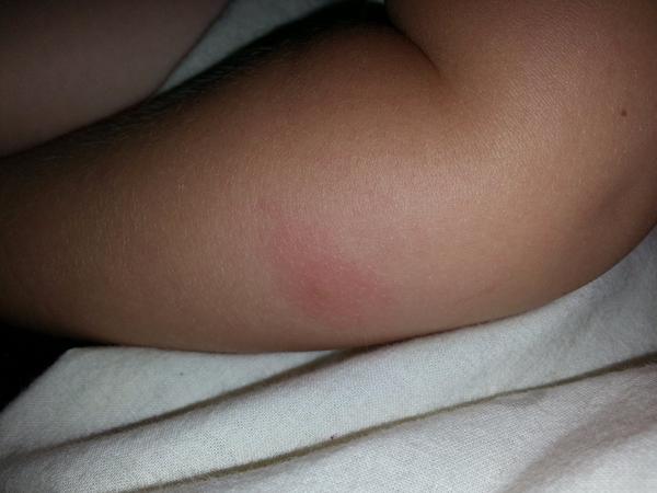 Mohly by to být neštovice?