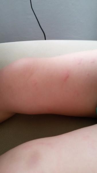 Vyrážka, co se objeví po spaní. Co to může být?