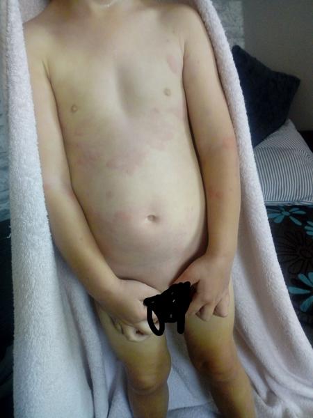 Vyrážka po nachlazení. Co by to mohlo být?