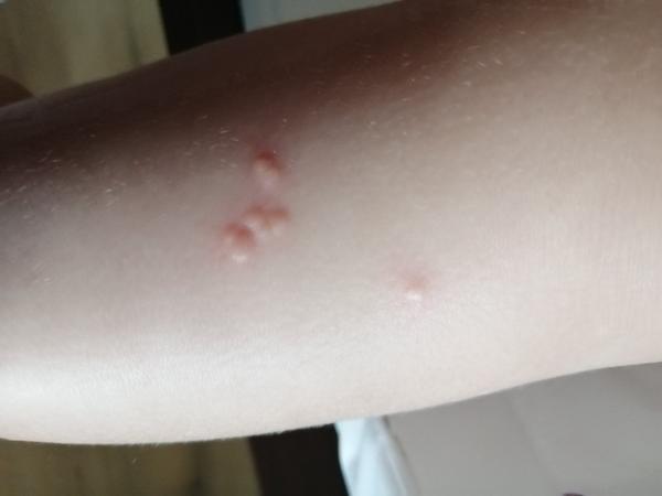 Boláčky na noze. Co to může být?