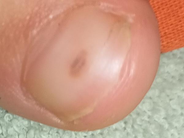 Hnědý flek na palci. Nevíte, o co jde?