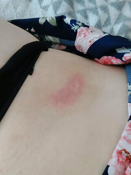 Příznaky po bodnutí hmyzem: Může jít o boreliózu?