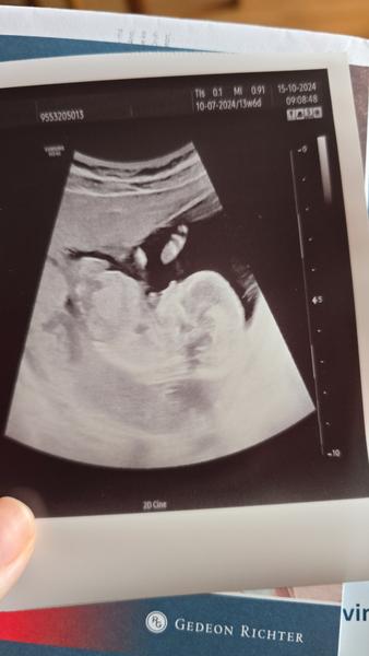 Jak odhadnout pohlaví z ultrazvuku ve 13. týdnu?