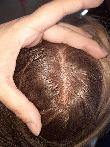 Červená kůže cihlové barvy ve vlasech. Je to opět seborea?