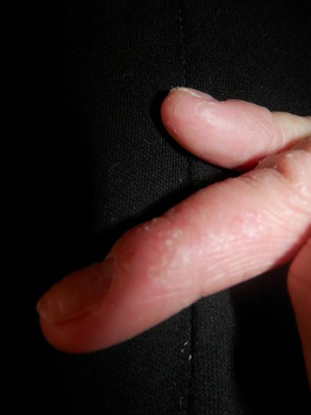 Zvlnění nehtů, může to být po gelových nehtech?