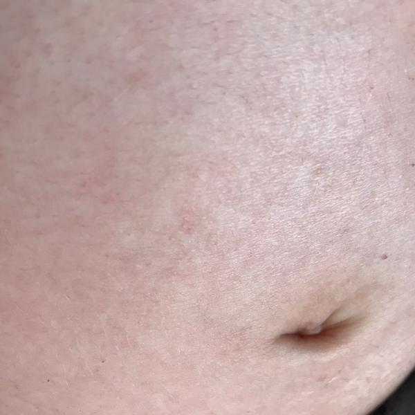 Těhotenské břicho-osypané. Mám letět k doktorovi?