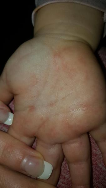 Podrážděné dlaně. Co byste doporučila na zklidnění?