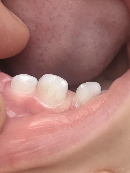 Zvláštní zabarvení zubu miminka. Nevíte, co to je?