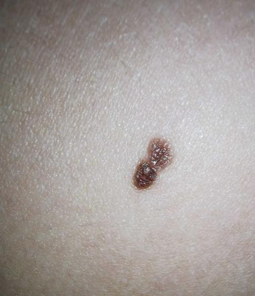 Jak poznat rizikové znaménko a rakovinu kůže?