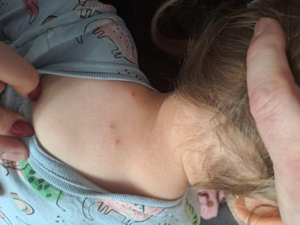 Puchýřky u dítěte. Může jít o alergickou reakci?