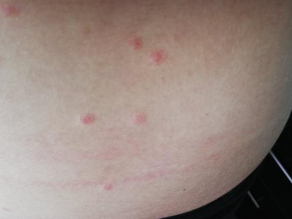 Neštovice podruhé ve 30 letech. Mohly by to být?