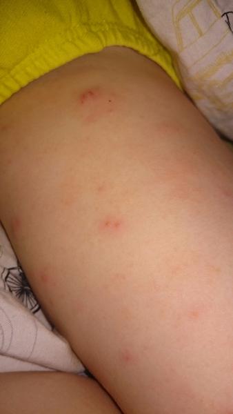 Pupínky na nohou - impetigo?