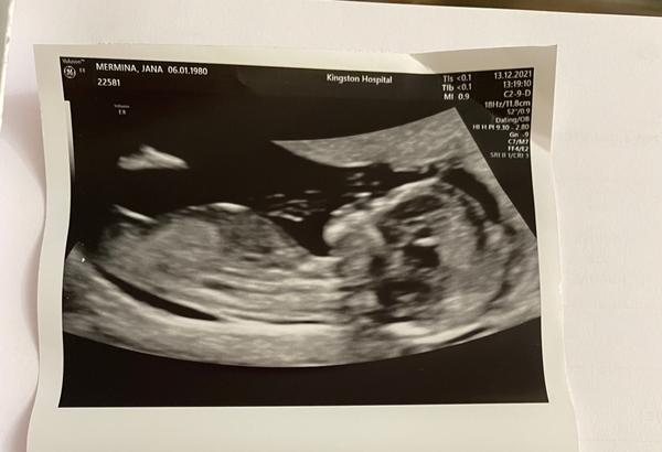 Ultrazvuk ve třináctém a šestnáctém týdnu: Pohlaví dítěte?