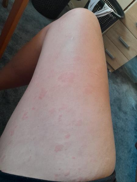 Svědivé pupínky po těle: Jaké jsou možné příčiny?