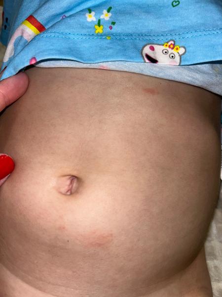 Locoid na atopický ekzém. Je to správné řešení?