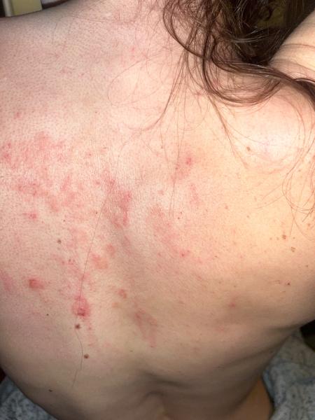 Vyrážka. O co by se mohlo jednat?