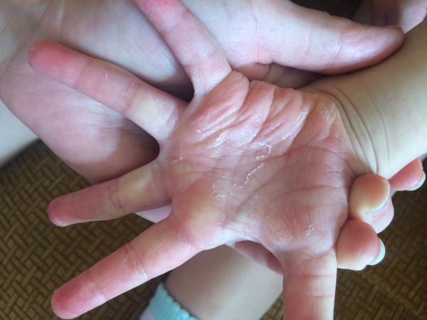 Drobné pupínky - je to plíseň nebo ekzém?