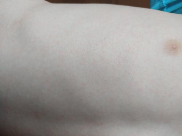 Vyrážka. Co by to mohlo být?