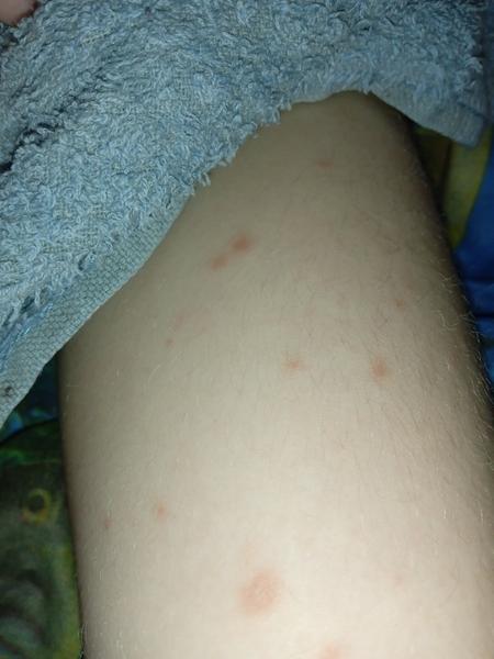 Mohou být růžové fleky příznakem neštovic?