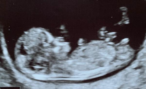 Lze určit pohlaví dítěte?