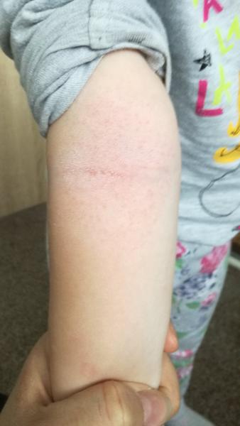 Kopřivka nebo neštovice. Co myslíte?