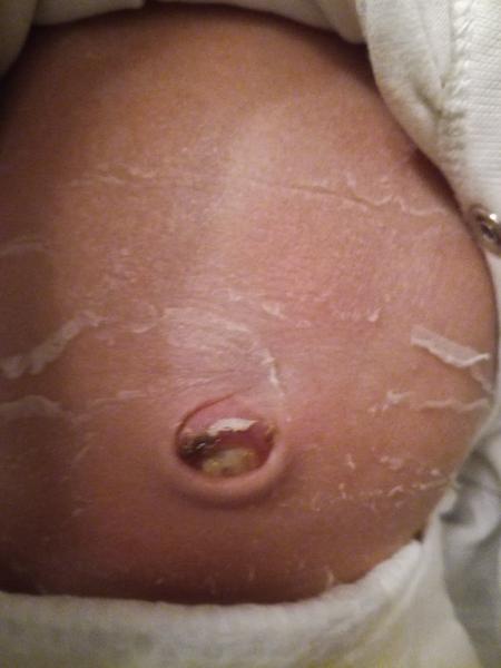 Pupeční pahýl, pod ním to je "čerstvé"