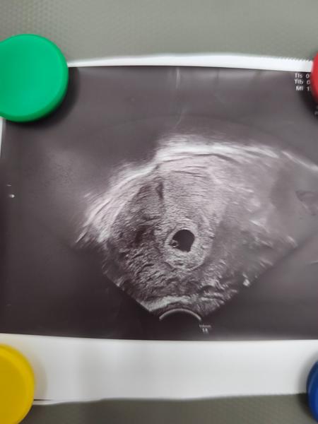 8tt a na ultrazvuku byl vidět pouze žloutkový a gestační váček