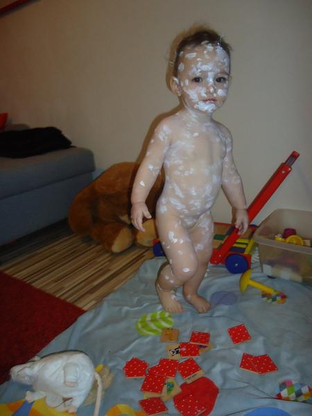 Neštovice-koupání v hypermanganu ano x ne? Uleví jí to?