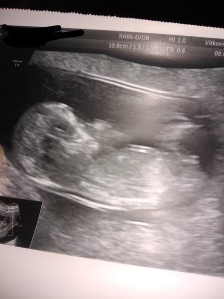 Pohlaví podle hrbolku. Tipl by si někdo?