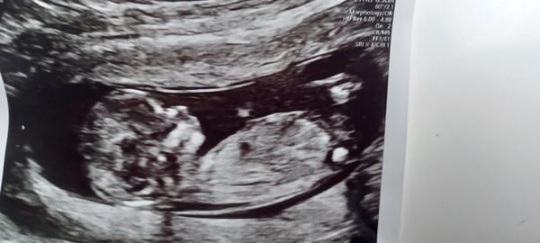 Jaké je pohlaví miminka?