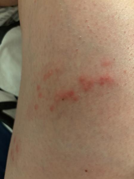 Může se jednat o svrab, nebo je to něco jiného?