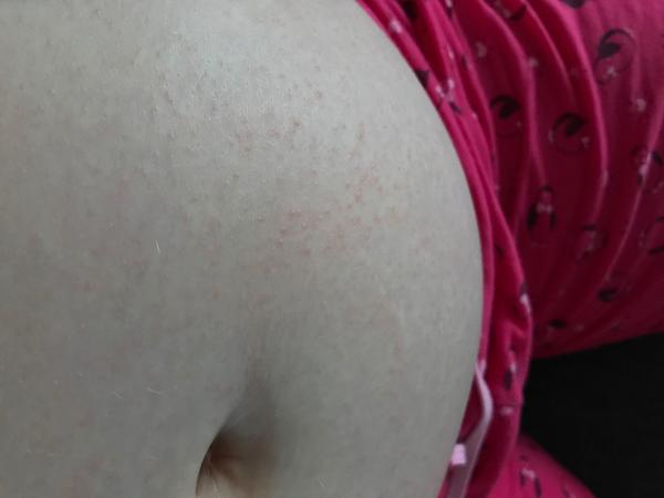 Svědění a vyrážka. Máte někdo na břiše? Vyhledat lékaře?