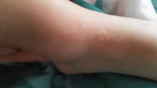 Pupínky na noze u 2leté dcerky. Poradíte, prosím?