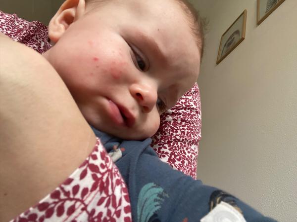 Co může být příčinou vyrážky na tváři šestiměsíčního miminka?