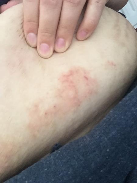 Vyrážka v těhotenství. Co koupit, aby to zmizelo?