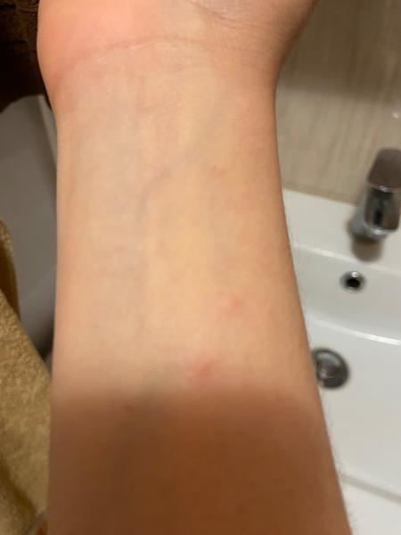 Jak poznat příznaky svrabu a jak předcházet nákaze?