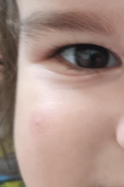 Pupínky s červenými fleky okolo. Co by to mohlo být?