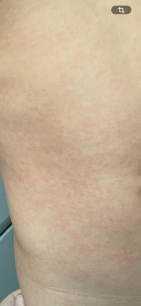 Jedná se o příznaky spály?